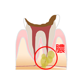 根尖病巣